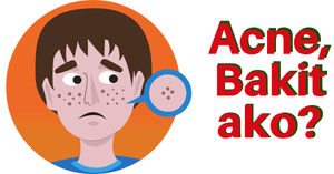 What Is Acne? - Symptoms & Treatment